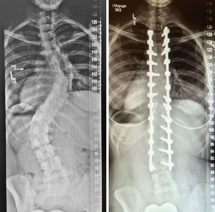 “X-rays of my spinal fusion surgery, before and after”