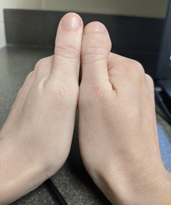 “I was born with one normal thumb and one toe thumb.”