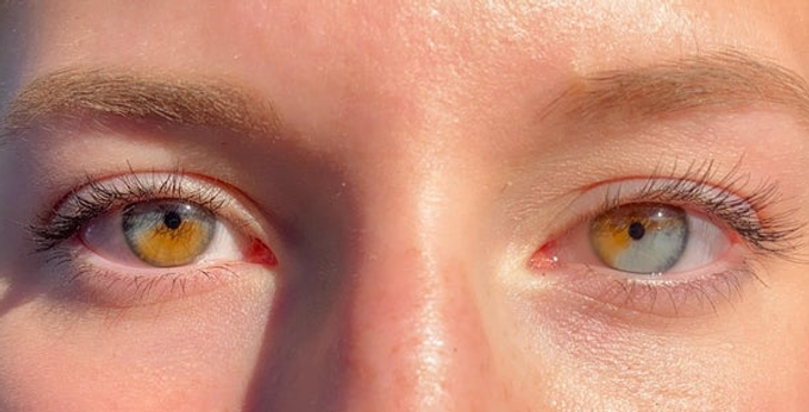 “I have partial heterochromia in both eyes.”