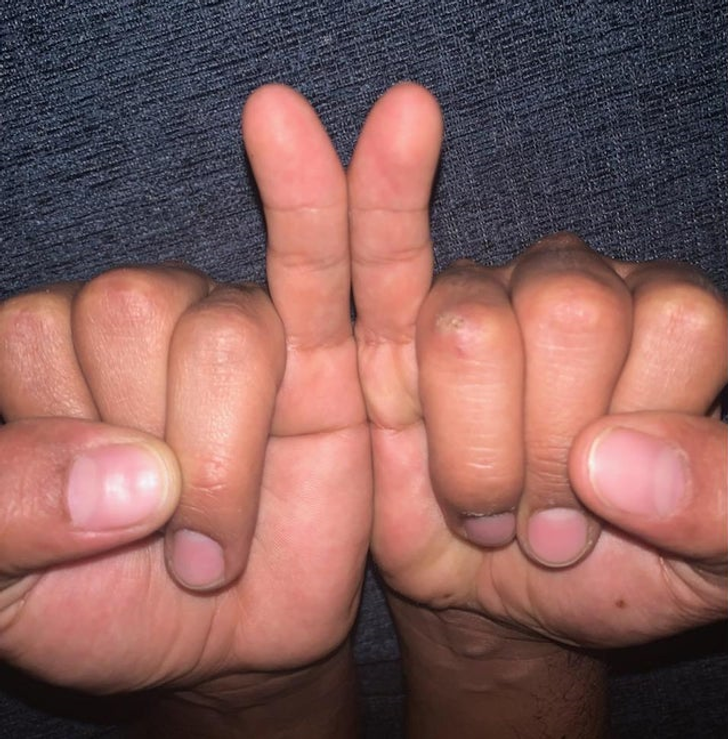 “Me and some members of my family have this genetic mutation called Clinodactyly, our pinky fingers are bent inward.”