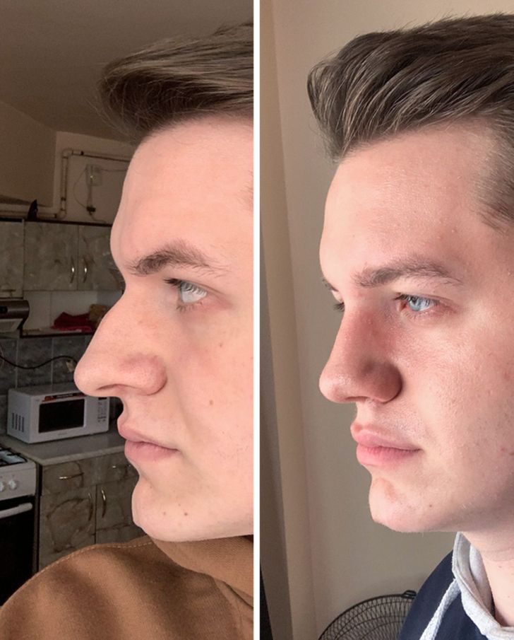 “21 months, before and after, 11 days post-op”