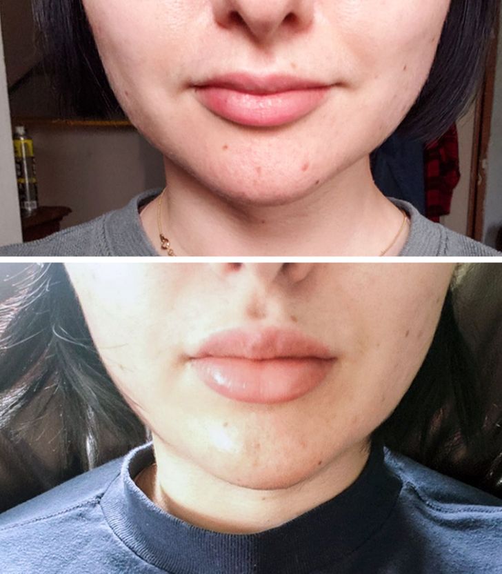 “Before and after masseter and lips — I’m so happy with the results so far! No more jaw pain.”