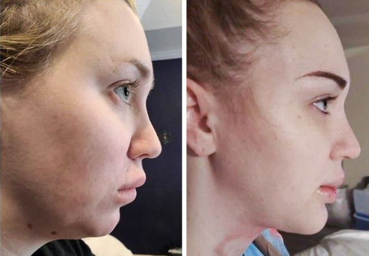 “Before and after, post-op, day 0”