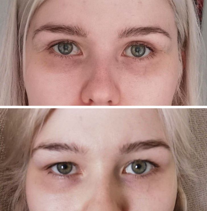 “Upper eyelid correction, before and after”