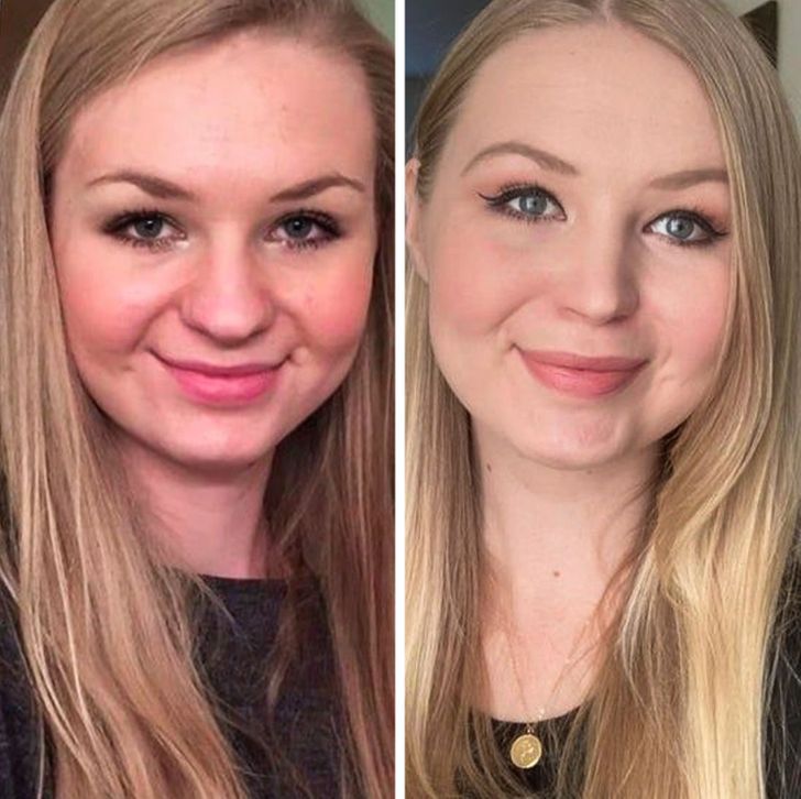 “Before and after: It took over 2 years for the swelling to completely dissipate.”