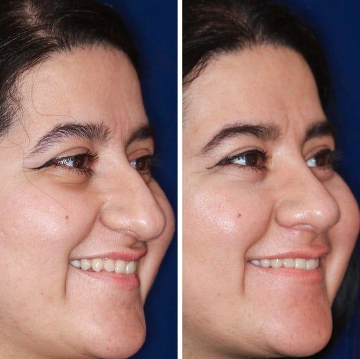 “Pre-op and 5 months post-op: a smiling difference!”