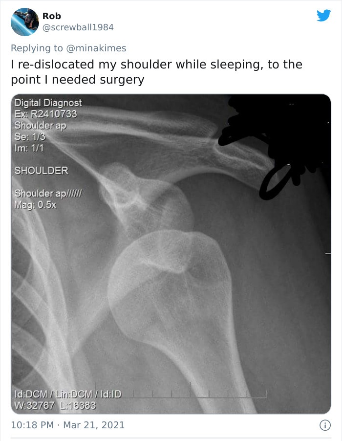 funny injury fails - I redislocated my shoulder while sleeping, to the point I needed surgery