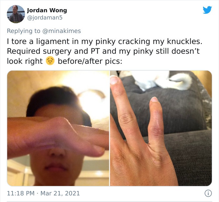 funny injury fails - I tore a ligament in my pinky cracking my knuckles. Required surgery and Pt and my pinky still doesn't look right before after pics