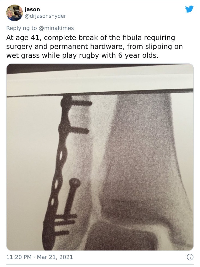 funny injury fails - At age 41, complete break of the fibula requiring surgery and permanent hardware, from slipping on wet grass while play rugby with 6 year olds.