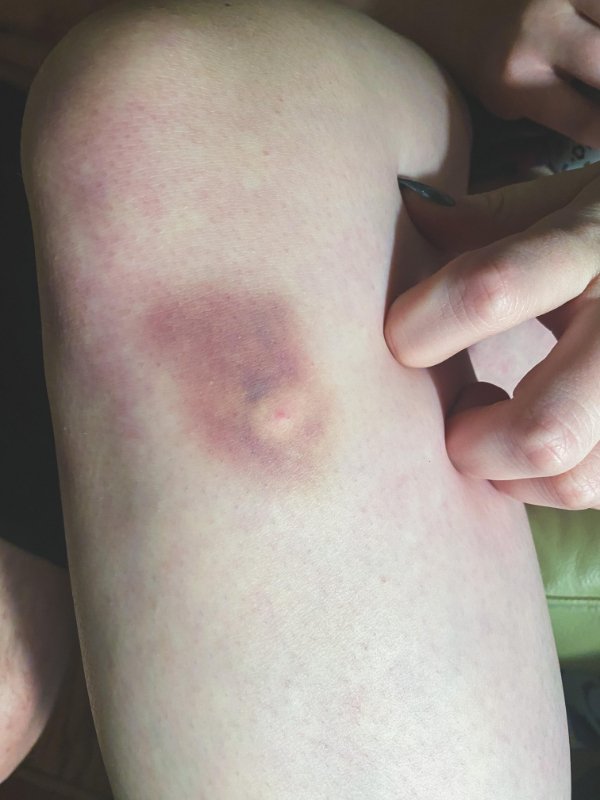 “I got a mosquito bite on top of a bruise and it drained the blood from the impact site.”