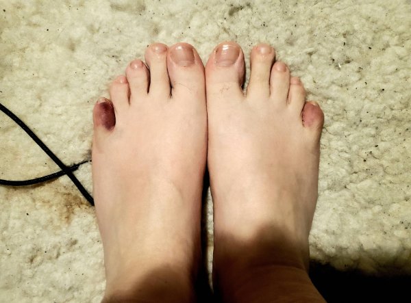 “Stubbed both my little toes today.”