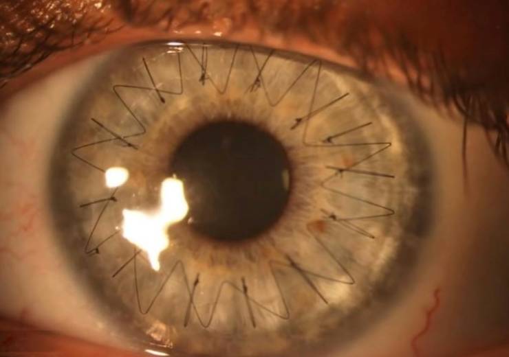 “What an eyeball looks like after a cornea transplant.”