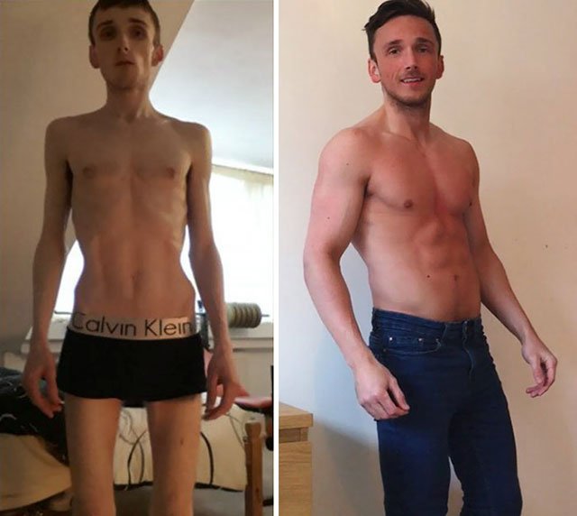22 People Who Beat Anorexia.