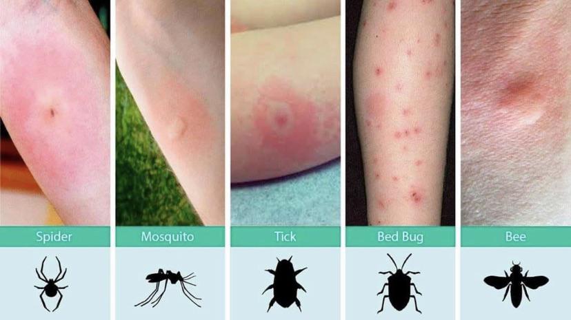 different types of bug bites - Spider Mosquito Tick Bed Bug Bee
