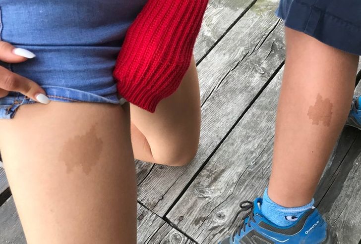 “My girlfriend and my nephew have a very similar birthmark despite the fact that they aren’t related at all.”