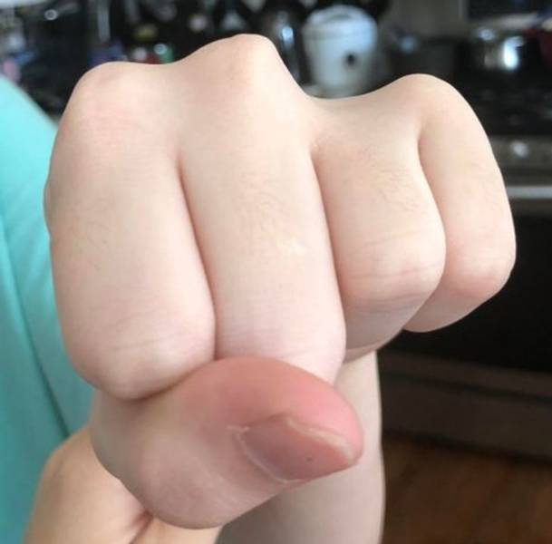 “My sister has a missing Knuckle. Her finger still works but it’s just short.”