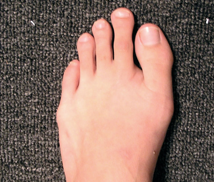 10% of people have something called Morton's toe. It's when your big toe is shorter than the one next to it. The Statue of Liberty actually has a Morton's toe as well.