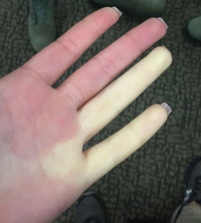 4% of people have Raynaud's syndrome. This is when a part of your body, usually your fingers or toes, starts to turn white when exposed to low temperatures. It's your body's overreaction to cold or distress.