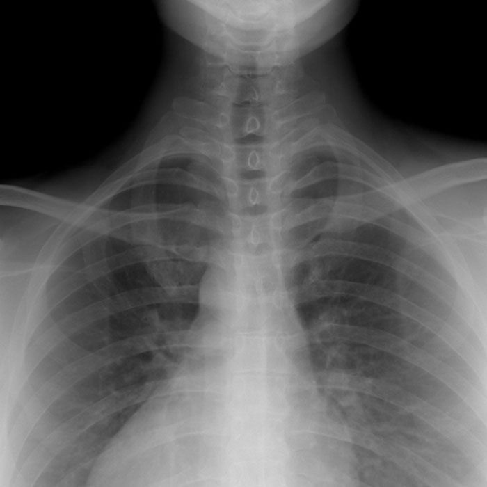 Less than 1% of people have an extra rib. Most people are born with 24, but some have 25 ribs. The 25th is called a cervical rib.