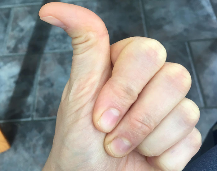 25% of people have a Hitchhiker's thumb - when the upper part of the thumb can bend 90 degrees backwards. It's caused by a certain gene.