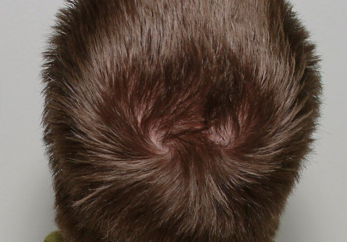 5% of people have a double hair whorl.