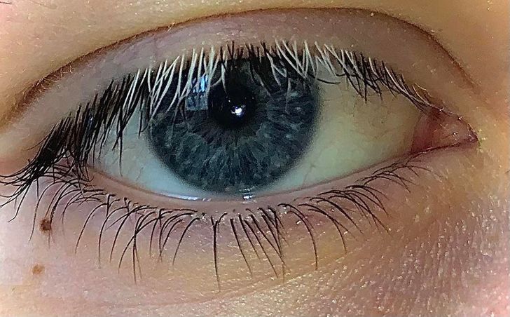 “My eyelashes on my right eye started growing in white a few months ago.”