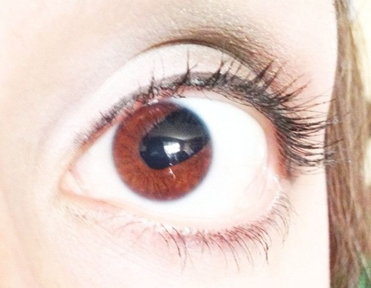 “This is my sister’s eye. She has a condition called ’Coloboma.’”