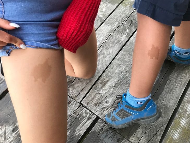 “My girlfriend and my nephew have a very similar birthmark despite that they aren’t related at all.”