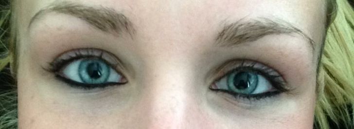 Anisocoria (unequal pupil sizes)