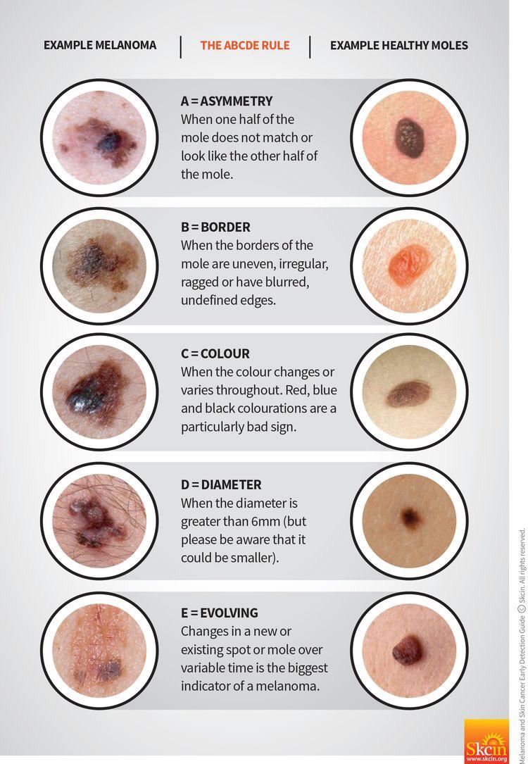 skin cancer moles - Example Melanomat The Abcde Rule Example Healthy Moles A Asymmetry When one half of the mole does not match or look the other half of the mole. BBorder When the borders of the mole are uneven, irregular, ragged or have blurred, undefin