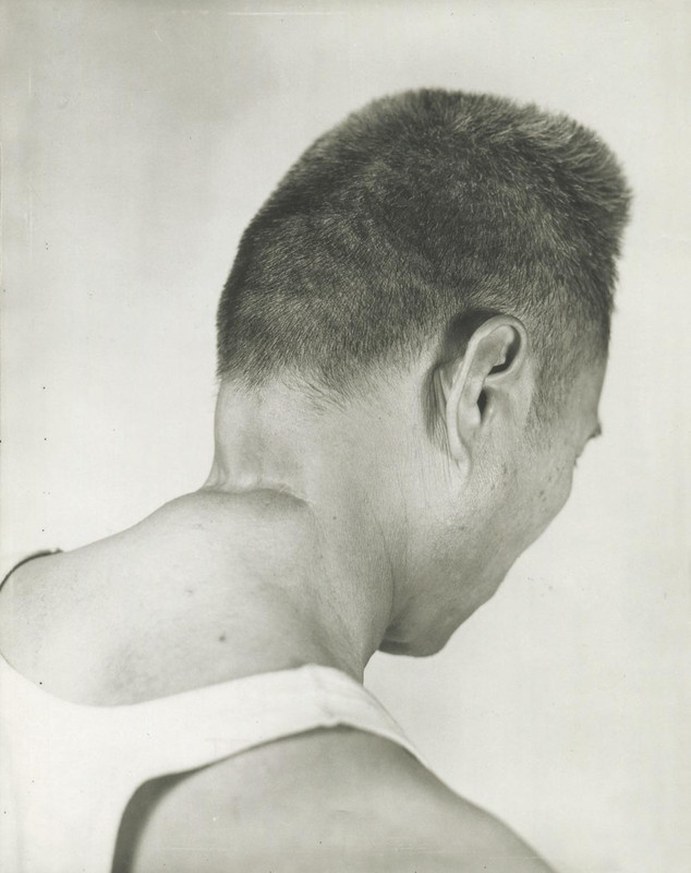 A Filipino survivor of the Manila massacre, shows where a Japanese officer tried to behead him 1945