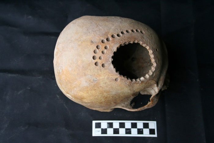 Brain Surgery In 1997, archaeologists discovered an ancient tomb in the French village of Ensisheim from 5,000 BC, which contained the decomposing body of a 50-year-old man with holes in his skull. After a thorough examination, it was determined that the holes, located near the frontal lobe, were caused by a type of surgery, not by forced trauma, and the operation appears to have been successful because the wounds healed before the patient's death. To this day, however, researchers cannot say for sure what exactly the surgery was trying to fix.