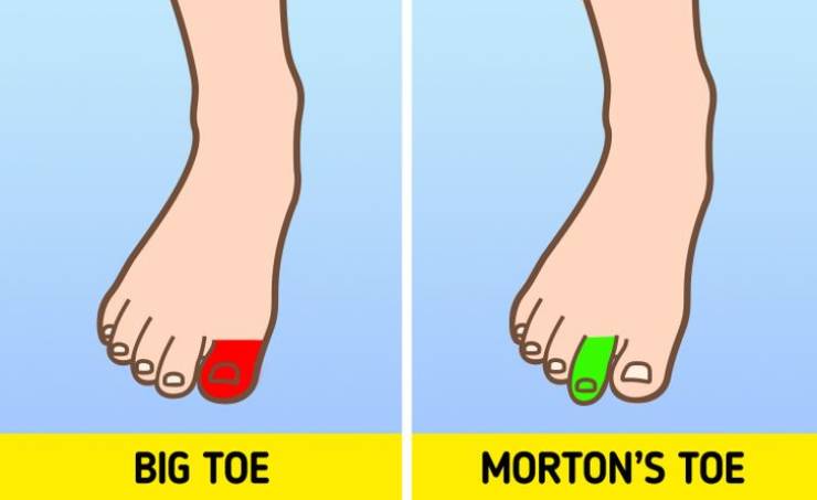 hand - ele Big Toe Morton'S Toe