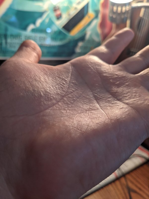 “One of my kids brought poison ivy into the house, now my hands look like this. Every bump is a blister.”