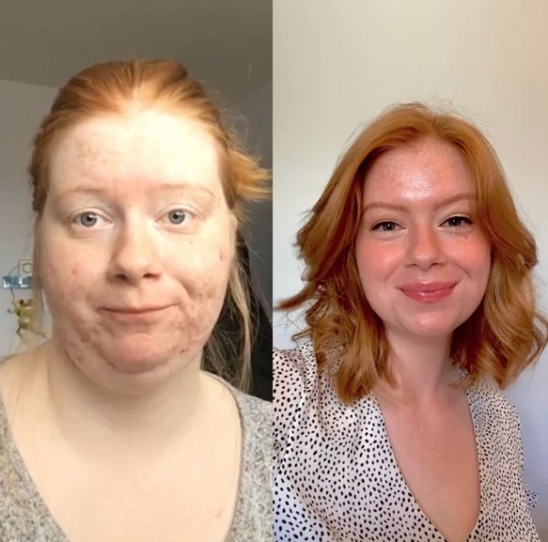 “[190 > 129 = -61lbs] I used to be afraid of having short hair cause of the weight in my face. Today, I said goodbye to the old me and embraced my new life!”