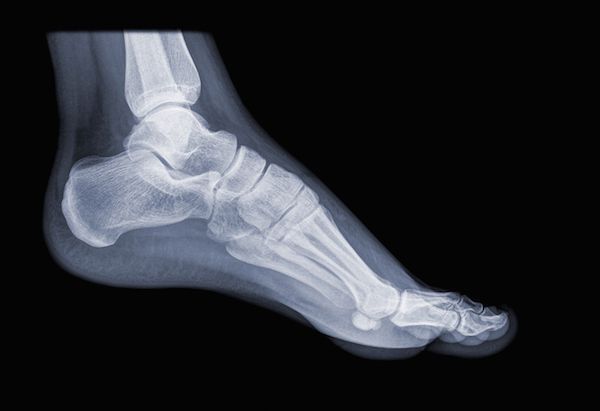 Shoe shops used X-Ray machines to fit shoes in the 1940s before the risks of X-Rays were discovered.