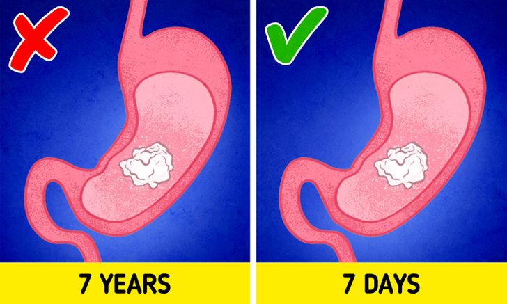 If you swallow gum, it stays in your stomach for 7 years. The truth: it is true that gum doesn’t get digested in your stomach, but it exits your body just like every other food. It certainly doesn’t stay in our stomach for 7 years, but instead, it leaves within 7 days. However, swallowing gum isn’t a good idea, since too much gum can block your intestines and cause constipation. That’s why you should be careful with this habit — especially with children.