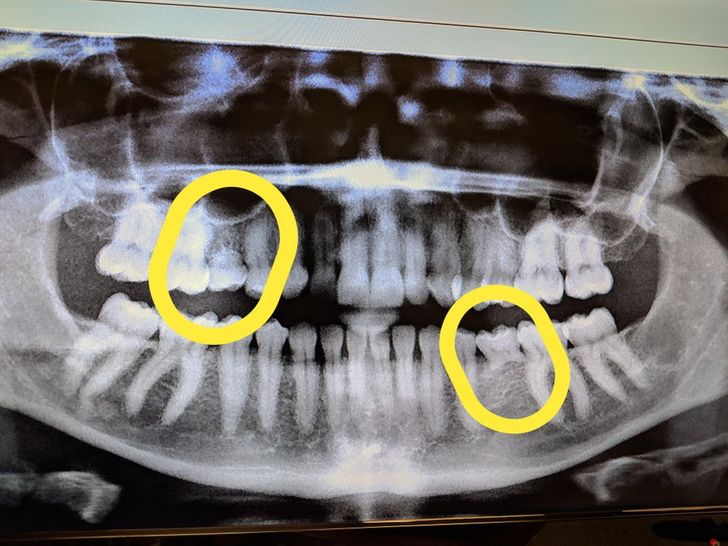 “The tooth fairy owes me a lot of money at this point. I’m 33 and here are my X-rays showing my remaining baby teeth.”