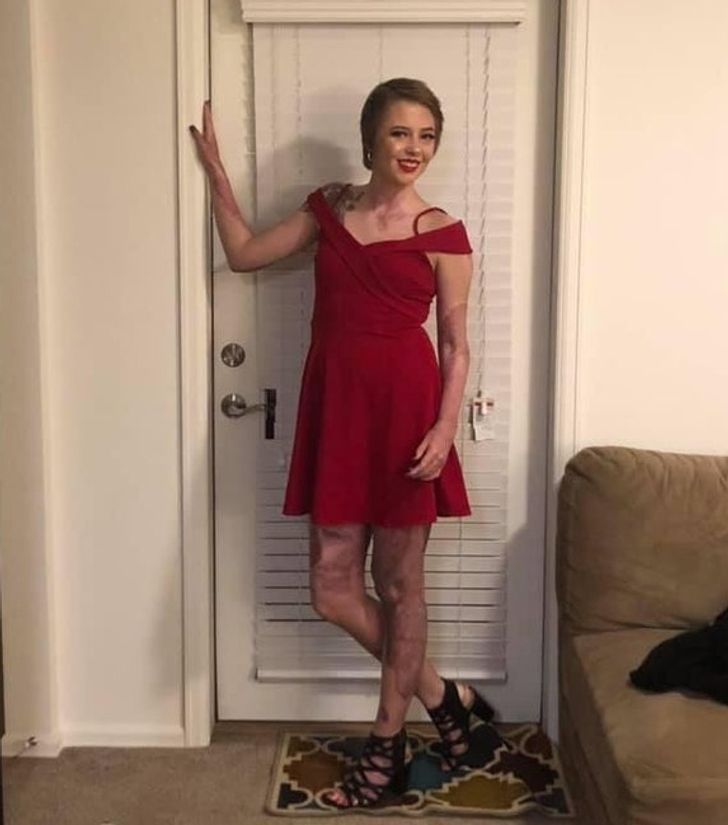 “Hey Mom, I wore a dress for the first time since I was in an explosion. It was so scary showing my scars for the first time. But I did it, and I still felt beautiful.”