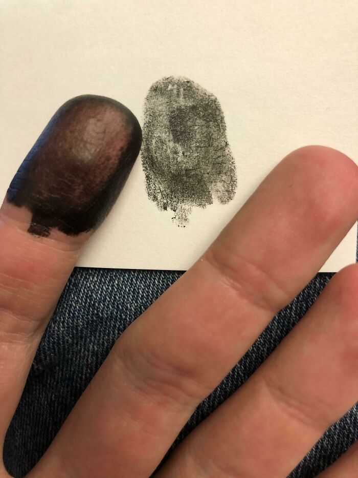 born without fingerprints