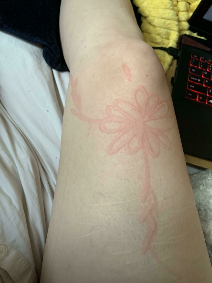 condition where you can draw on skin