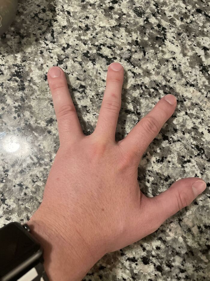 man with only 4 fingers reddit