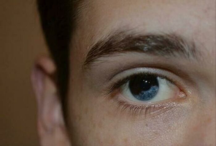 rare heterochromia