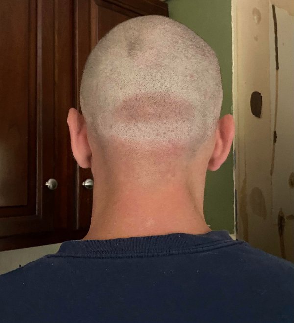 “My husband started a new job outside, he wore his hat for the first week, resulting in his new tan line.”