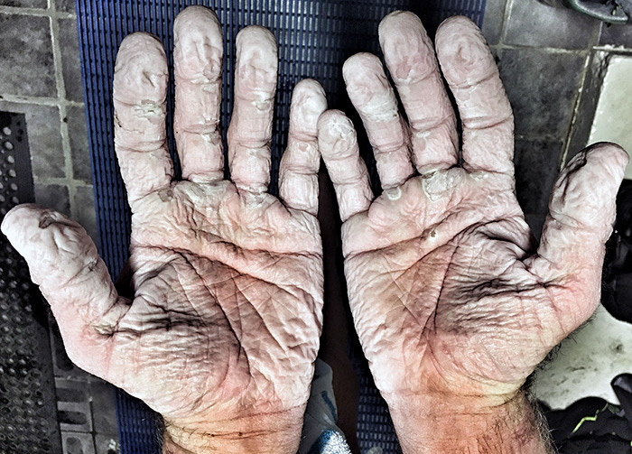 Olympic Rower’s Hands