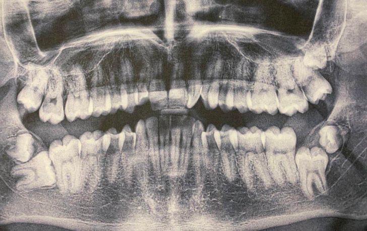 “I have 7 wisdom teeth (35 teeth in total). I am probably in the 0.0001%, but at the wrong competition.”