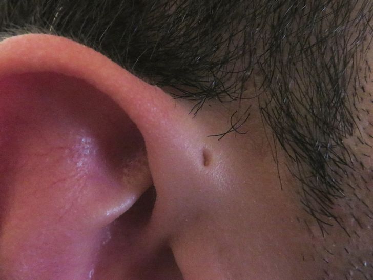 Preauricular sinus: a small hole located on the exterior of the ear