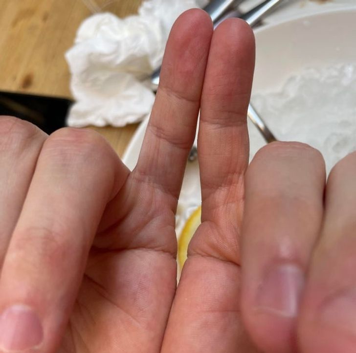 “My 30-year-old friend has just realized that his right pinkie has two phalanxes only.”