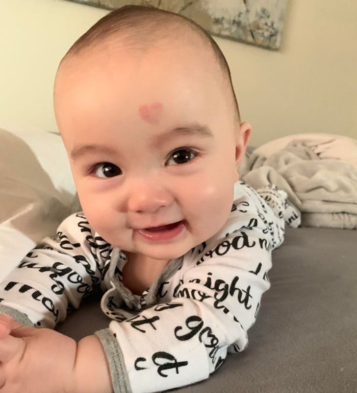 “My son’s amazing birthmark”