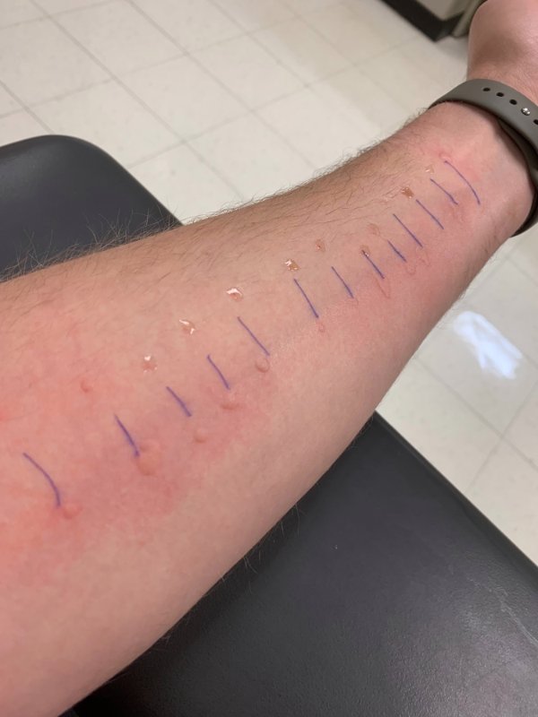 “I had my first allergy test today…”